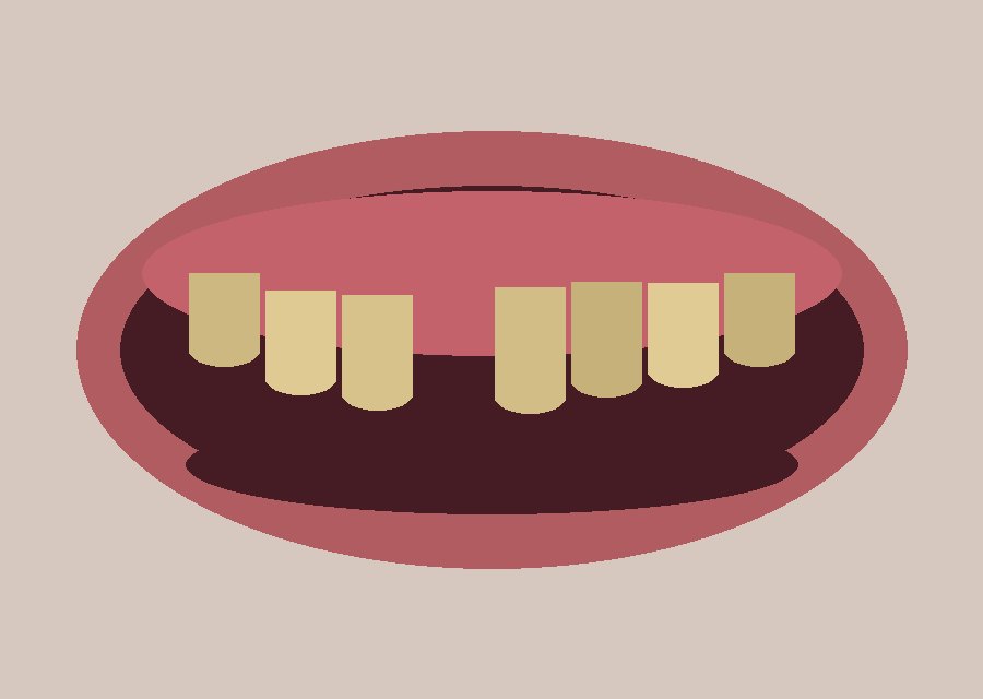 Bite correction with braces — Before